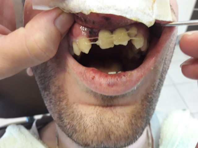 Trauma zuba