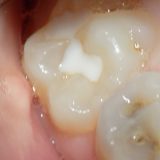 Zalivanje fisura zuba