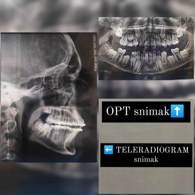 Prvi ortodontski pregled