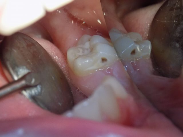 Zalivanje fisura zuba