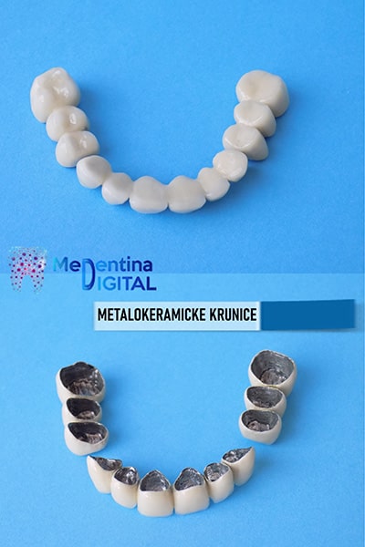 Stomatoloska protetika - fiksne nadoknade - metalne