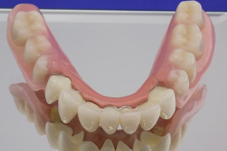 Mesto uboda kod anestezije gornjeg zuba (Žuta "linija" je nerv)