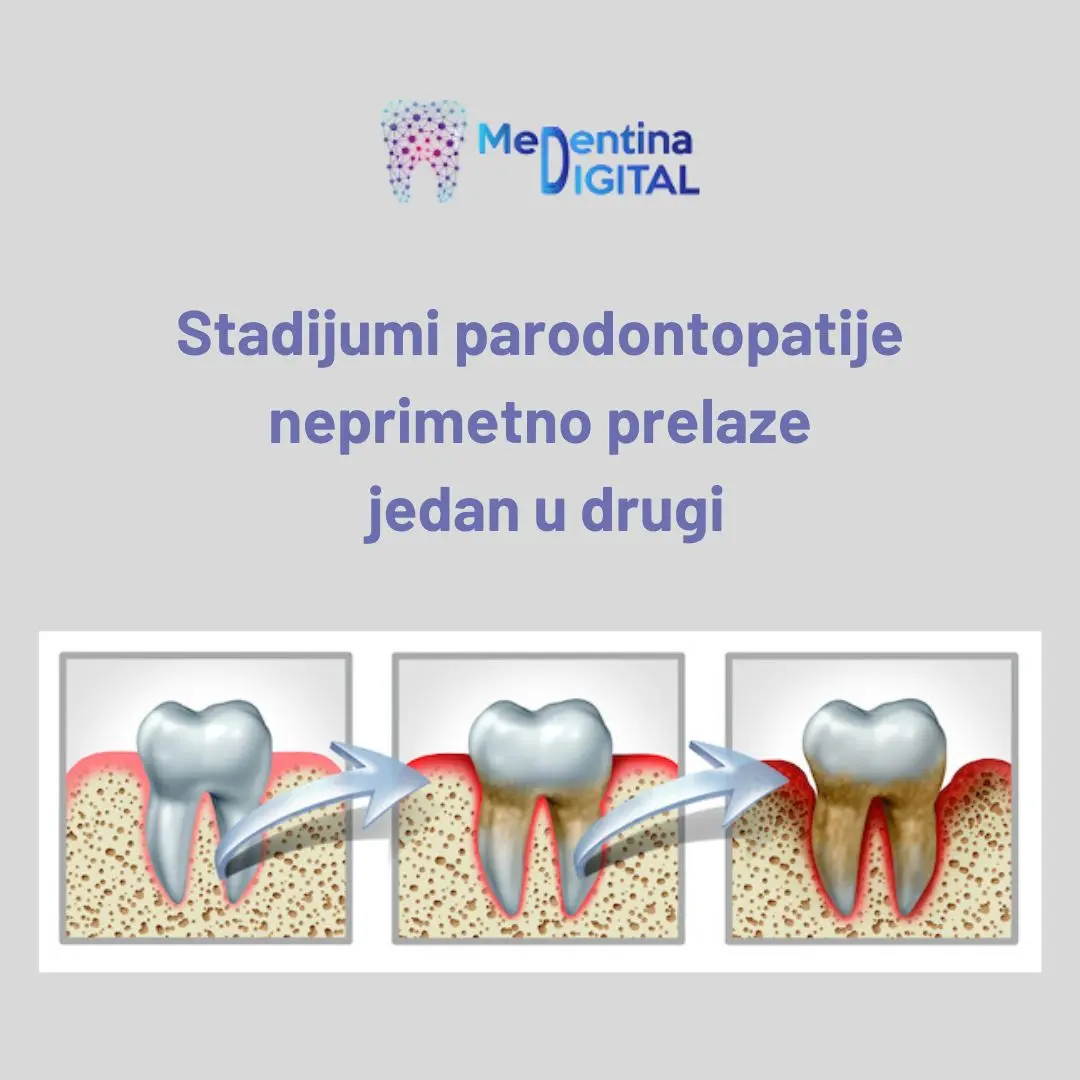 Simptomi i lecenje parodontopatije 2 https://medentinadigital.rs/wp-content/uploads/2025/03/Simptomi-i-lecenje-parodontopatije-2.webp