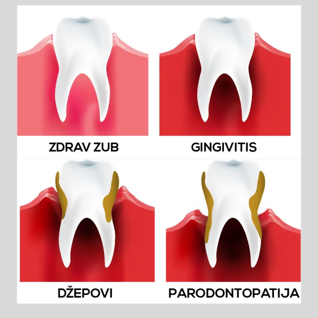 Simptomi i lecenje parodontopatije 4 https://medentinadigital.rs/wp-content/uploads/2025/03/Simptomi-i-lecenje-parodontopatije-4.webp