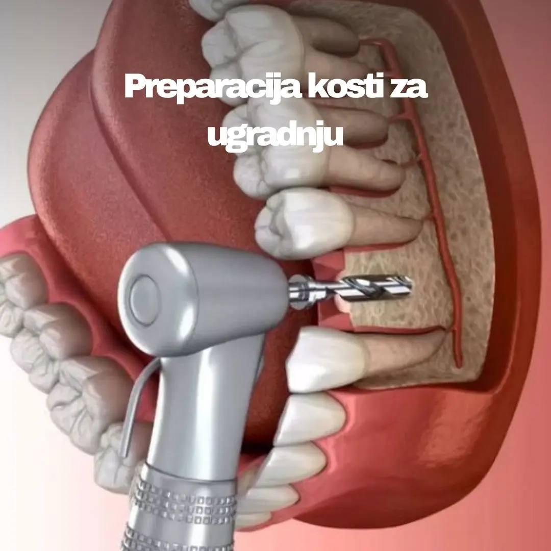 Ugradnja implantanta 2 https://medentinadigital.rs/wp-content/uploads/2025/05/Ugradnja-implantanta-2.webp