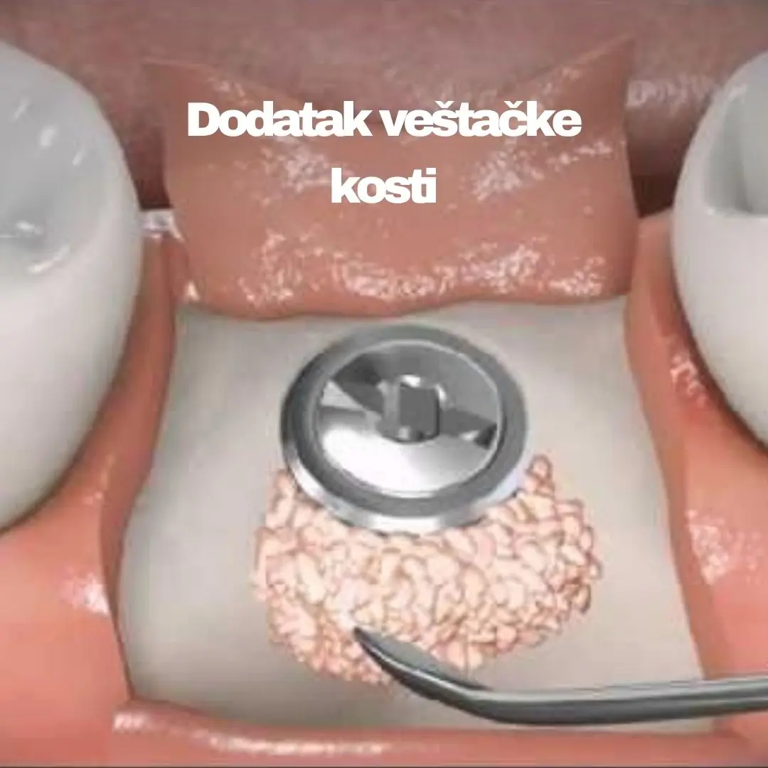 Ugradnja implantanta 3 https://medentinadigital.rs/wp-content/uploads/2025/05/Ugradnja-implantanta-3.webp