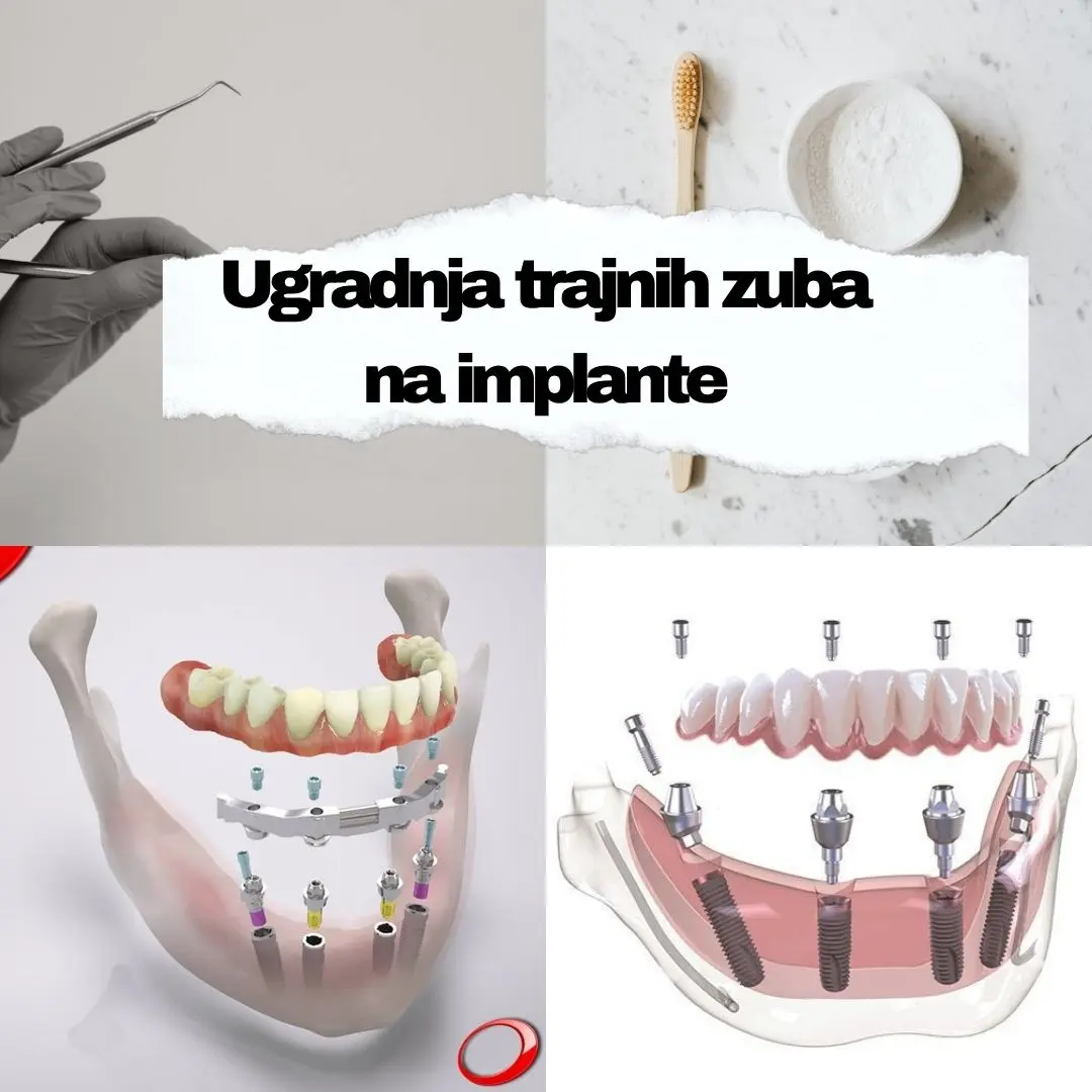 Ugradnja implantanta 4 https://medentinadigital.rs/wp-content/uploads/2025/05/Ugradnja-implantanta-4.webp
