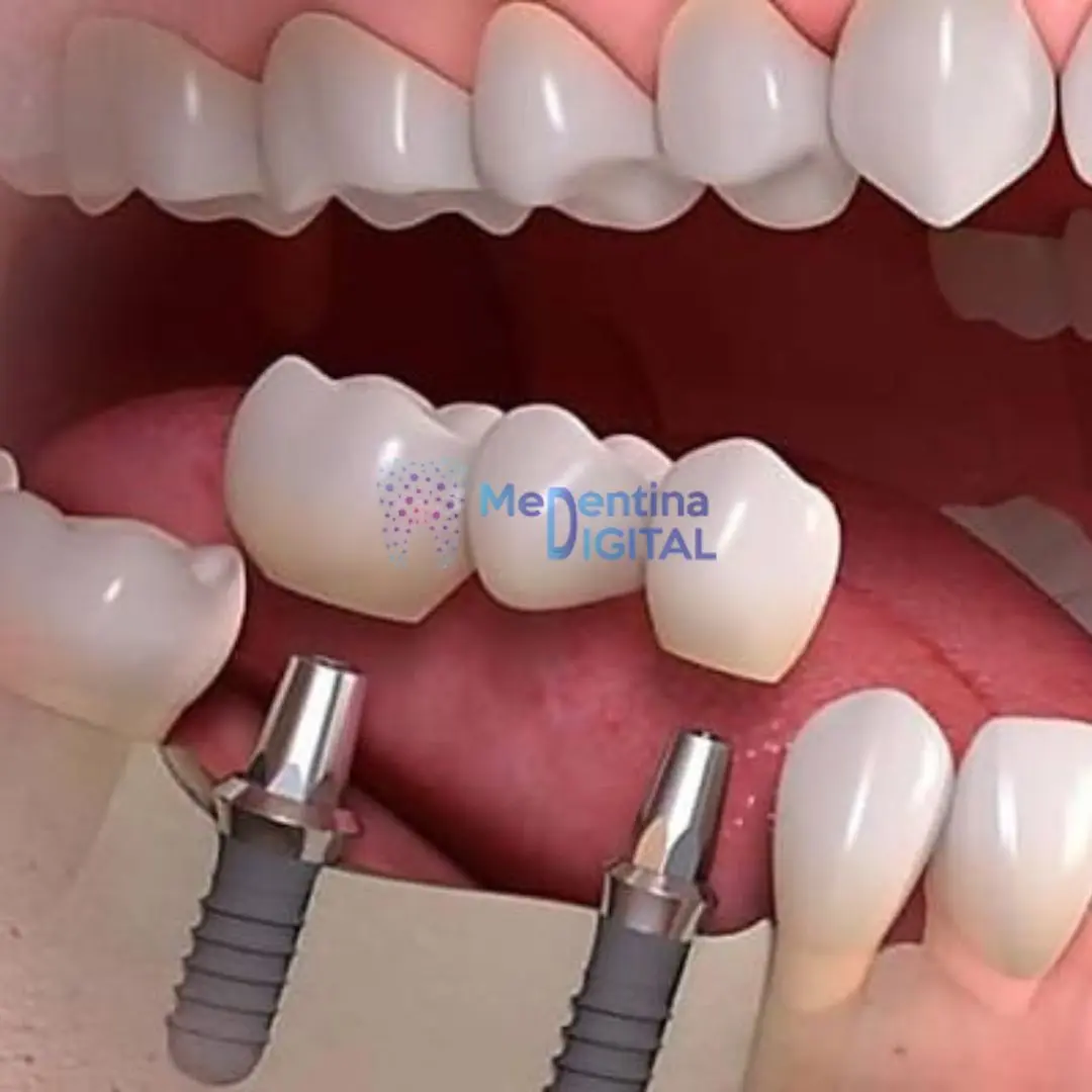 Sta je abatment 4 https://medentinadigital.rs/wp-content/uploads/2025/06/Sta-je-abatment-4.webp