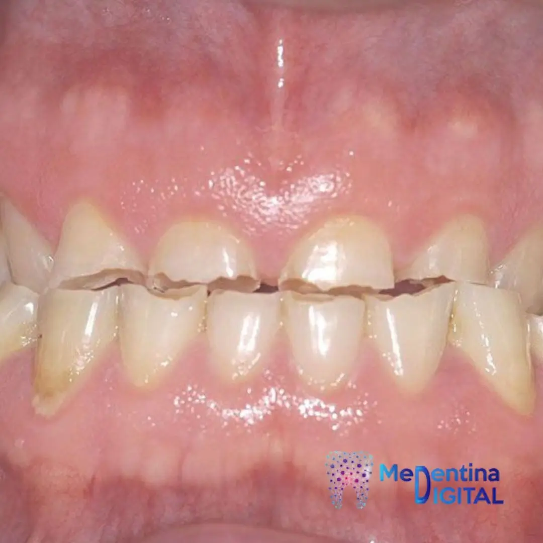 Bruksizam 1 https://medentinadigital.rs/wp-content/uploads/2025/10/Bruksizam-1.webp