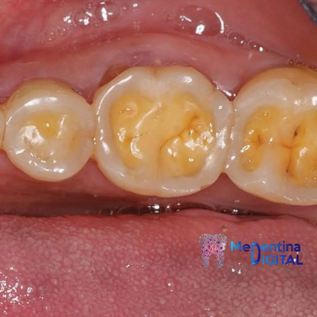 Bruksizam 2 https://medentinadigital.rs/wp-content/uploads/2025/10/Bruksizam-2.webp