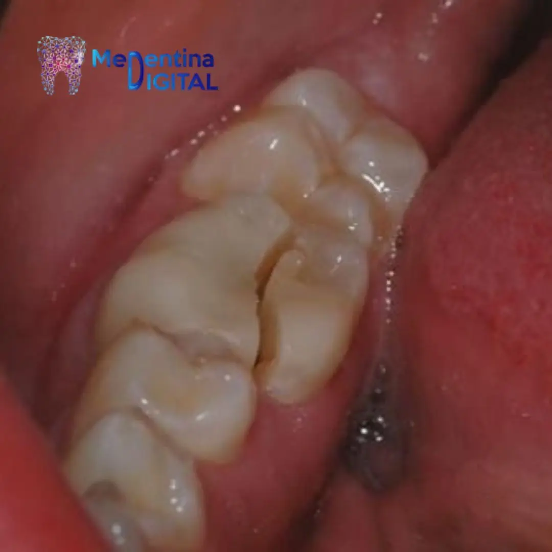 Bruksizam 3 https://medentinadigital.rs/wp-content/uploads/2025/10/Bruksizam-3.webp